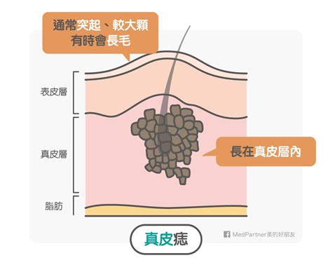 點痣 流血|點痣筆一擦，黑痣就掉了？醫師冷笑科科兩聲：「點痣。